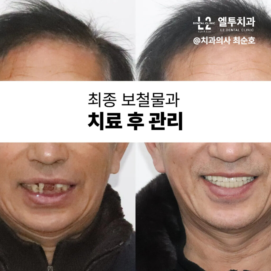 임플란트 최종 보철물 장착 후 치료 전후 비교