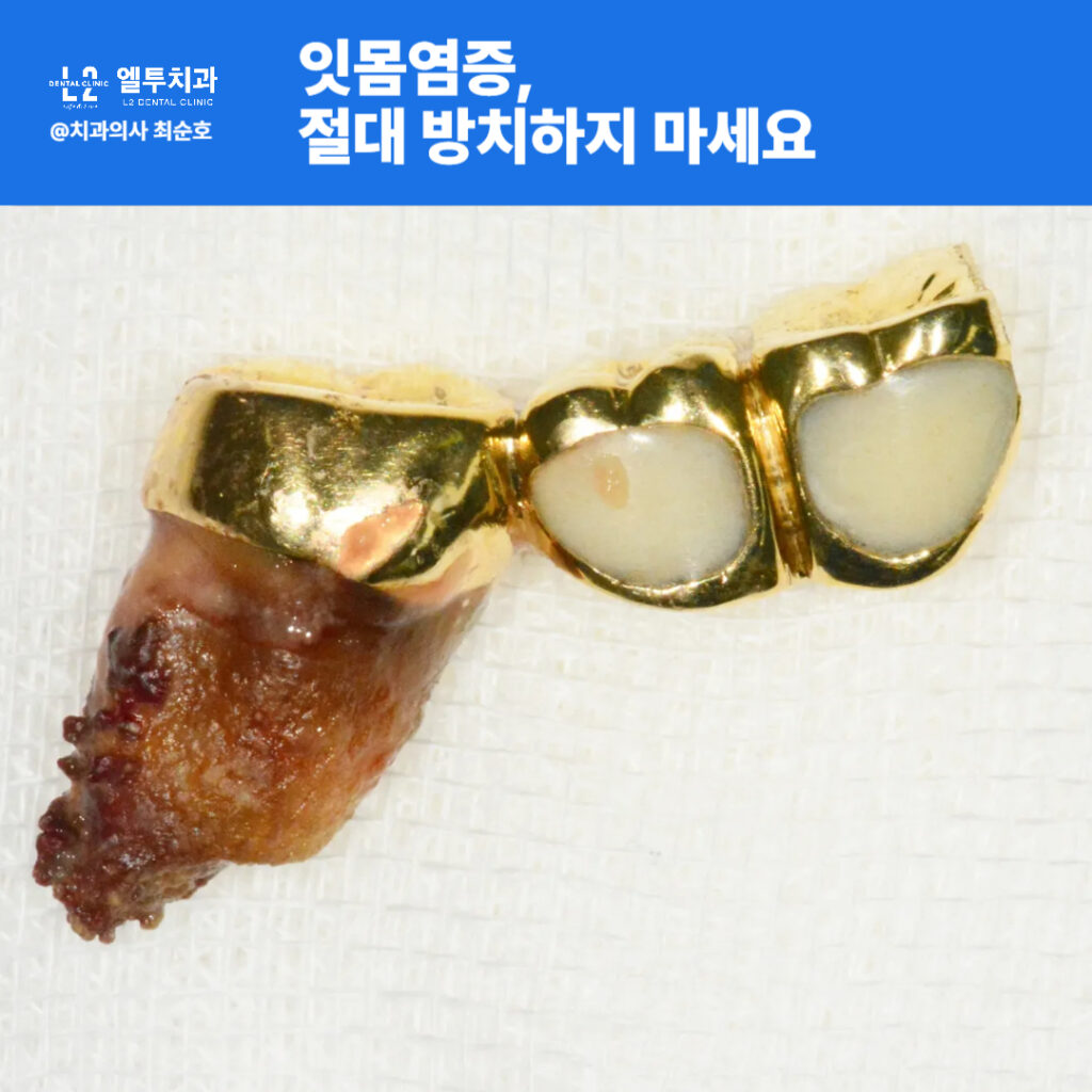 심한 풍치로 인해 발치된 치아와 연결된 금속 보철물