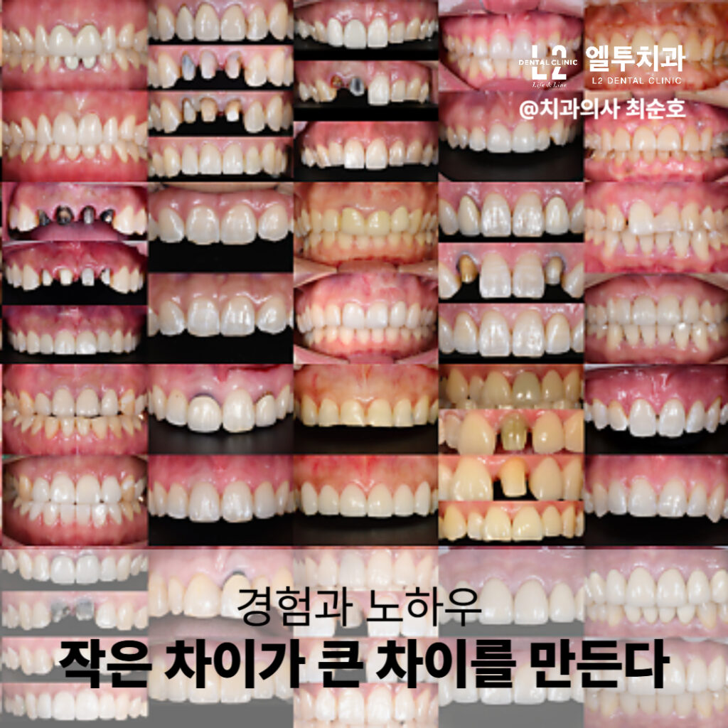 앞니 치료 전후 비교 이미지 모음