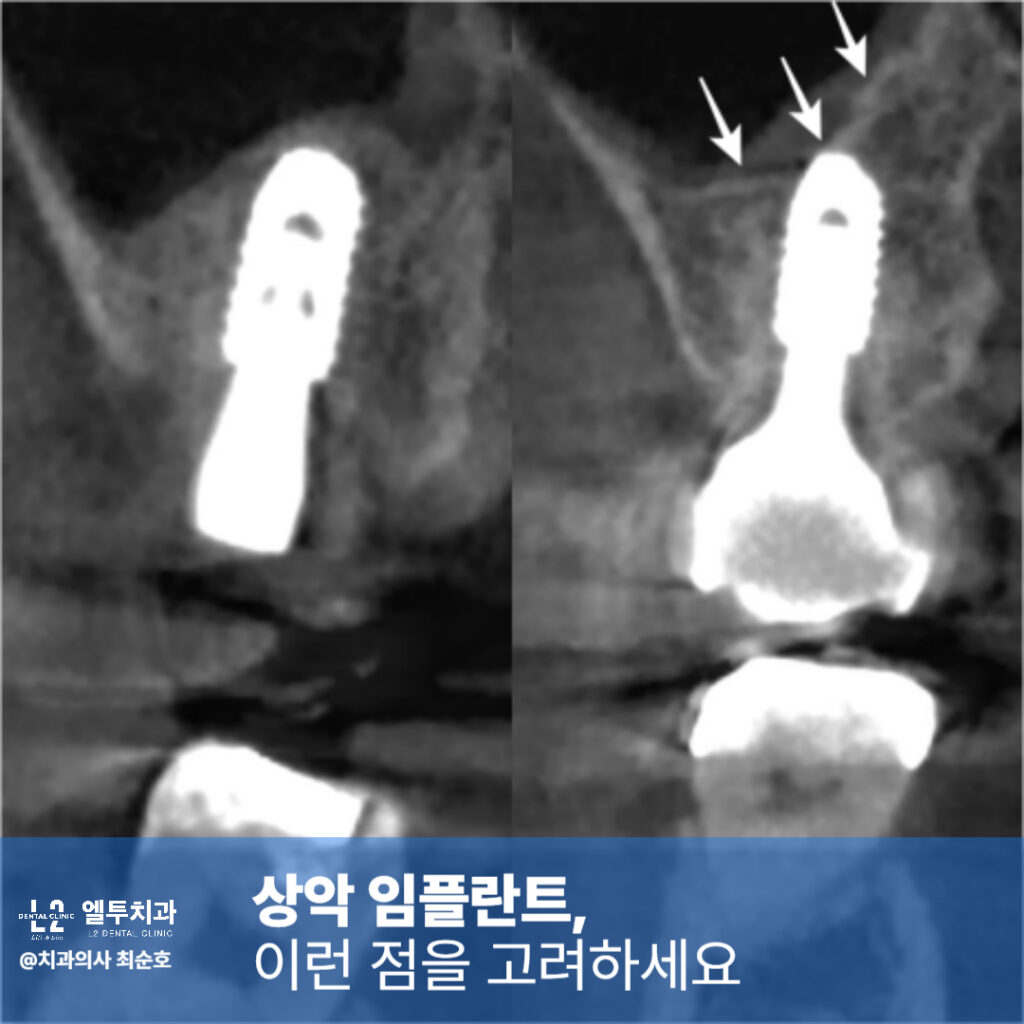 상악 임플란트 고려사항을 설명하는 CT 단면 이미지
