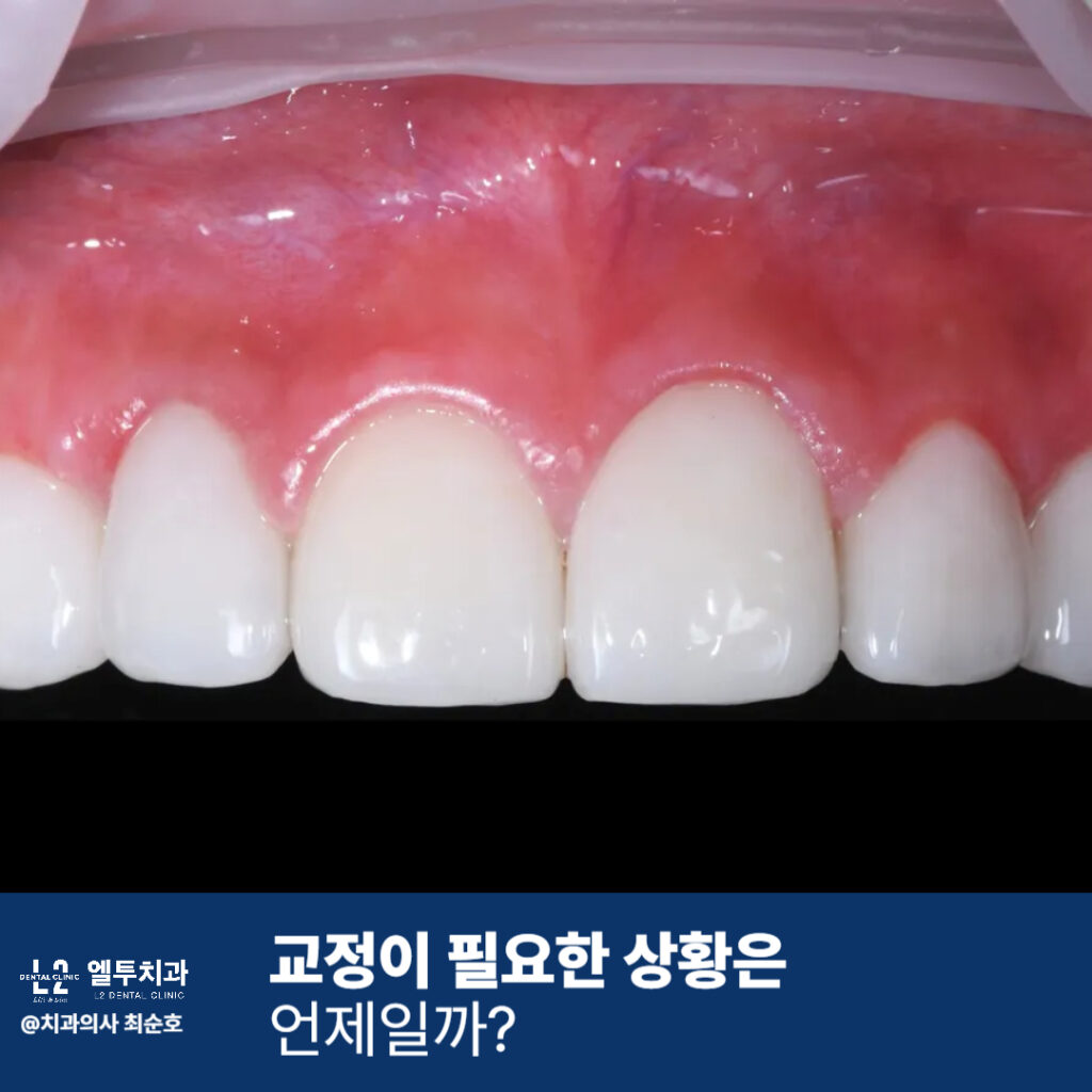 가지런하게 정렬된 앞니와 잇몸