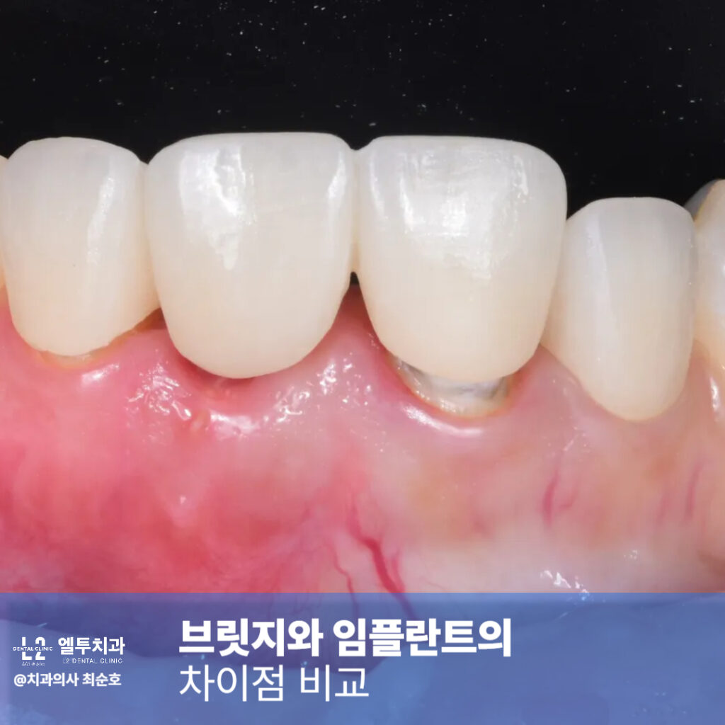 앞니보철 브릿지와 임플란트의 차이점 비교