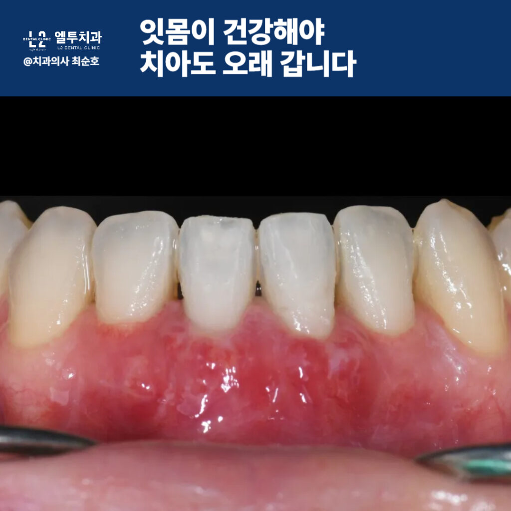건강한 잇몸라인과 퇴축되지 않은 치은 상태 사진