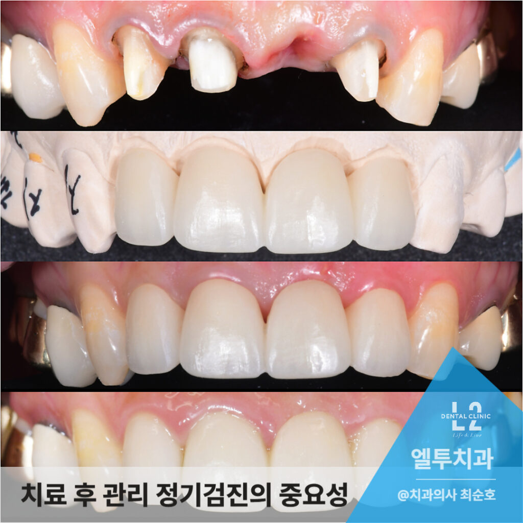 앞니보철 브릿지 치료 후 정기검진 중요성 강조 이미지