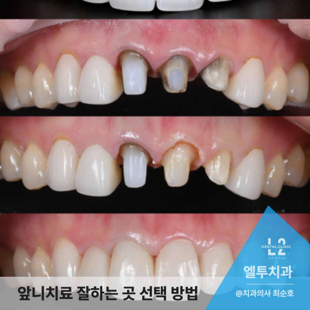 앞니 보철 치료 과정 중 크라운 제거 및 재치료 단계