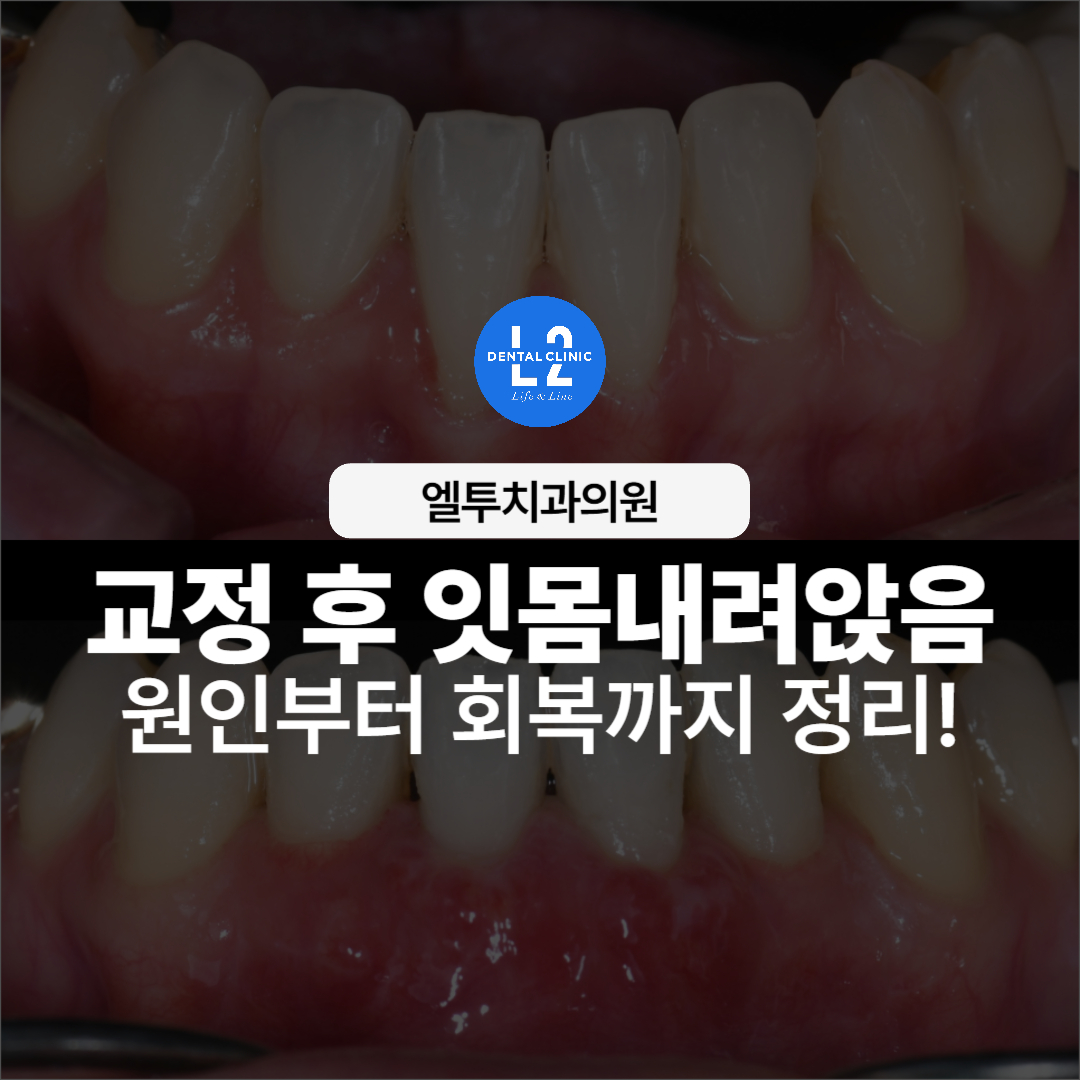 교정 후 잇몸이 내려앉은 치아 상태를 보여주는 대표 이미지