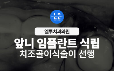 앞니 임플란트 식립, 왜 치조골이식술이 선행돼야 할까?