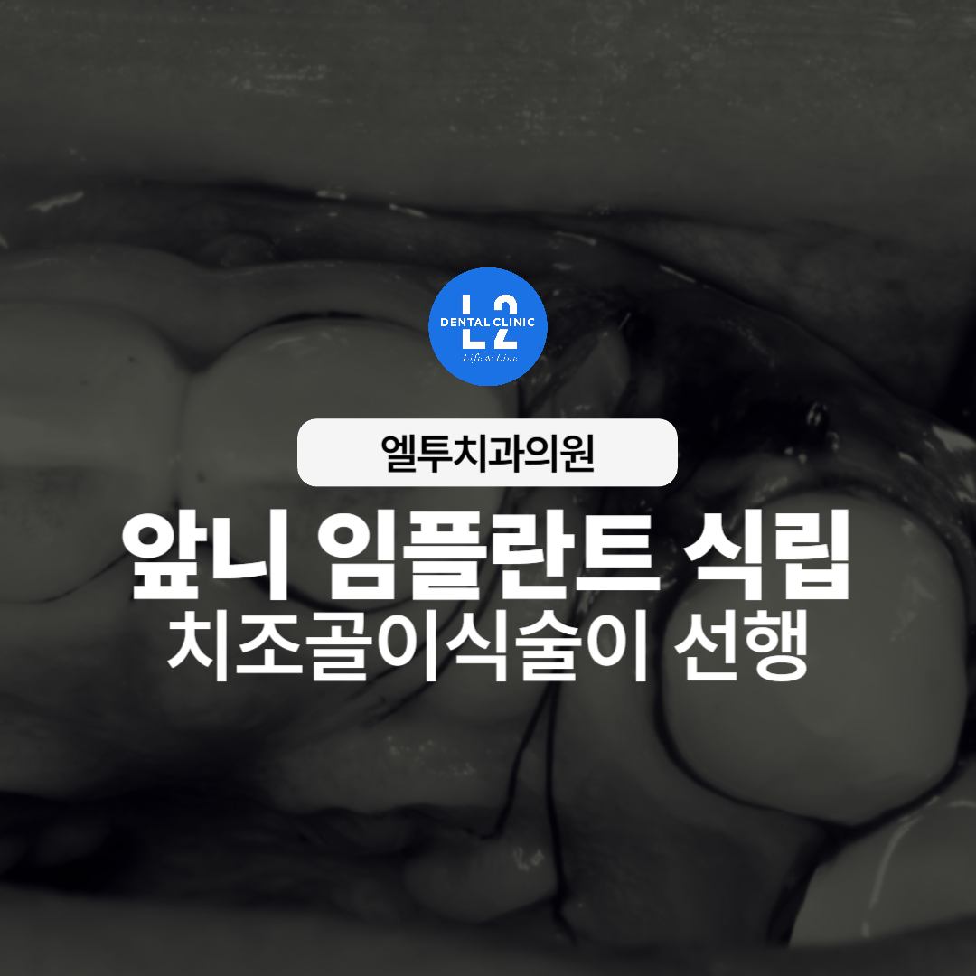 앞니 임플란트 식립과 치조골이식술을 강조한 타이틀 이미지