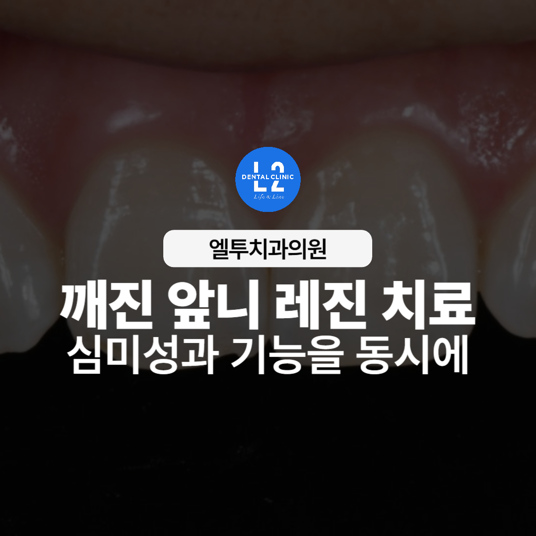 깨진 앞니 레진 치료 전 치아 사진과 심미·기능 회복 안내
