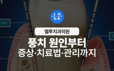 풍치 원인부터 증상·치료법·관리까지 한 번에 정리