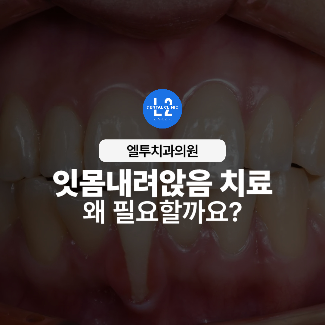 잇몸이 내려앉아 치아 뿌리가 노출된 앞니 모습
