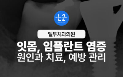 잇몸염증 임플란트 염증 원인과 치료, 예방 관리