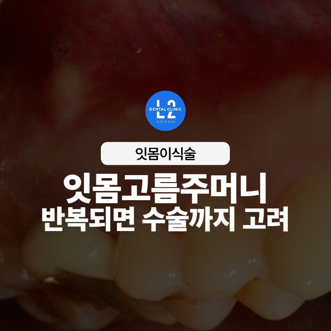 잇몸고름주머니 반복 시 수술 고려 안내 이미지