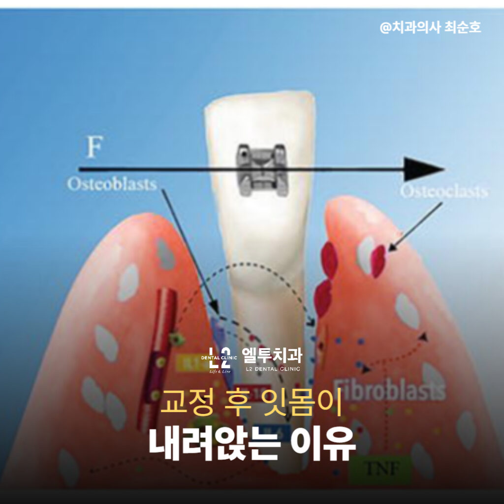 치아 이동에 따른 잇몸 및 치조골 구조 변화 모식도