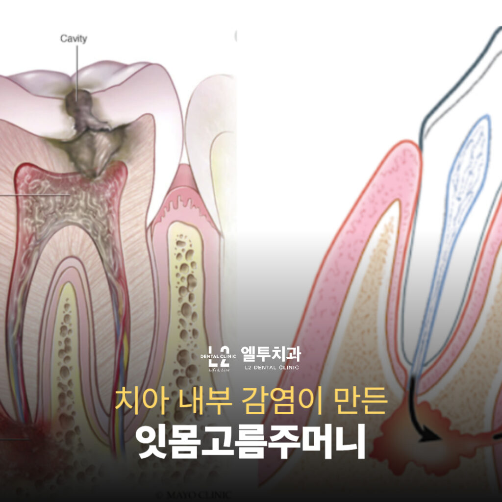 치아 내부 감염으로 인한 잇몸고름주머니의 해부도 이미지