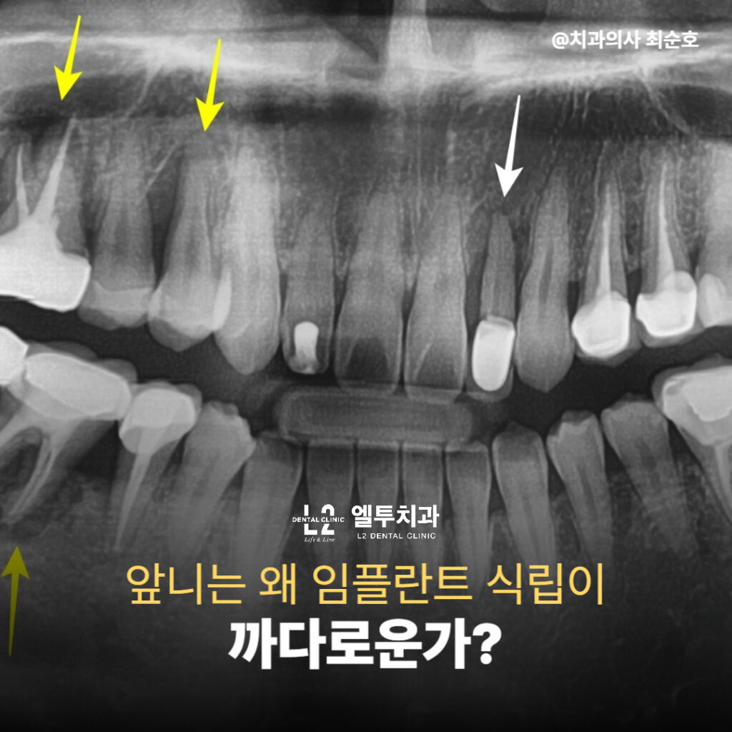 앞니 부위 X-ray 사진에 표시된 치조골 흡수 부위