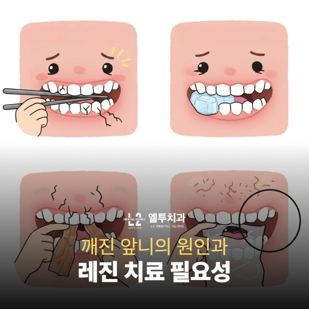 깨진 앞니 원인 예시 – 젓가락, 얼음, 마른오징어, 앞니로 봉지 뜯기