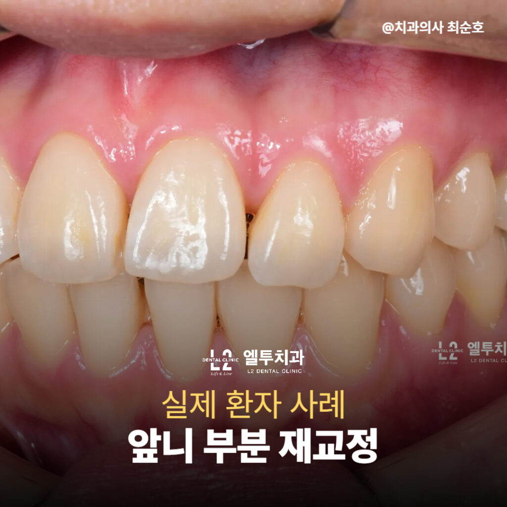 앞니 배열 틀어짐 환자의 재교정 전 치아 사진