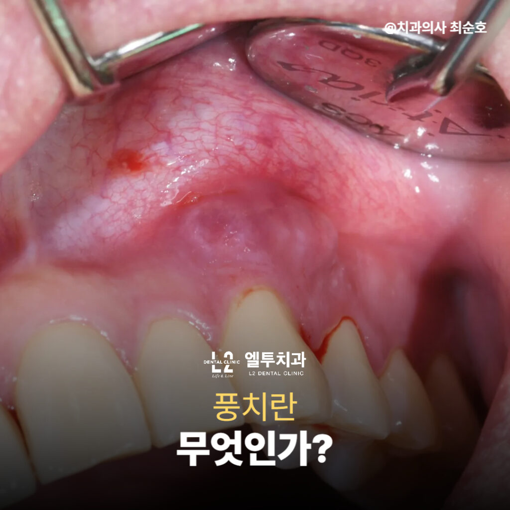 잇몸 염증과 출혈이 보이는 환자 구강 사진