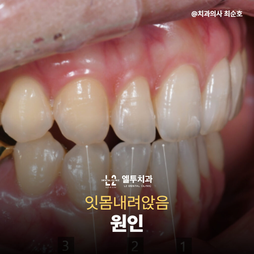 옆모습에서 관찰된 잇몸내려앉음 원인 부위
