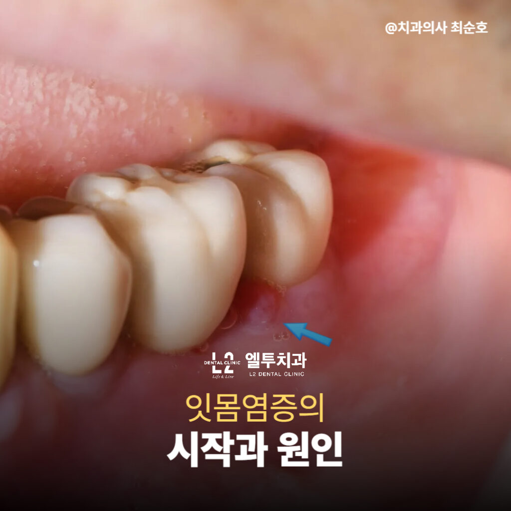자연치아 옆 잇몸에 염증이 발생한 모습