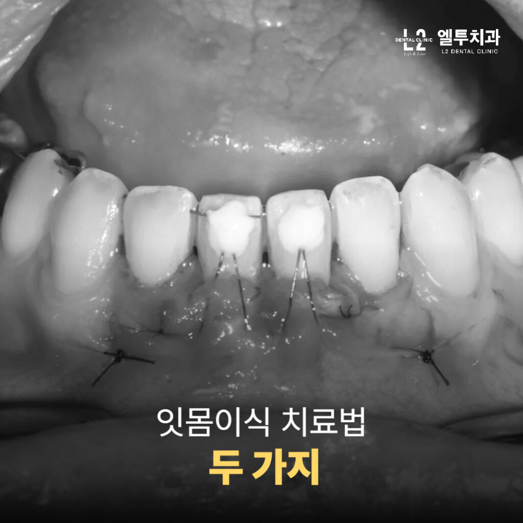 잇몸이식 수술 직후의 상태를 보여주는 흑백 임상 이미지