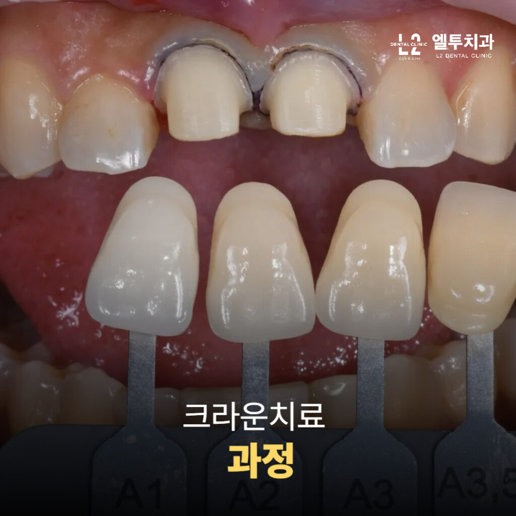 크라운 색상을 치아에 맞춰 선택하는 치료 과정