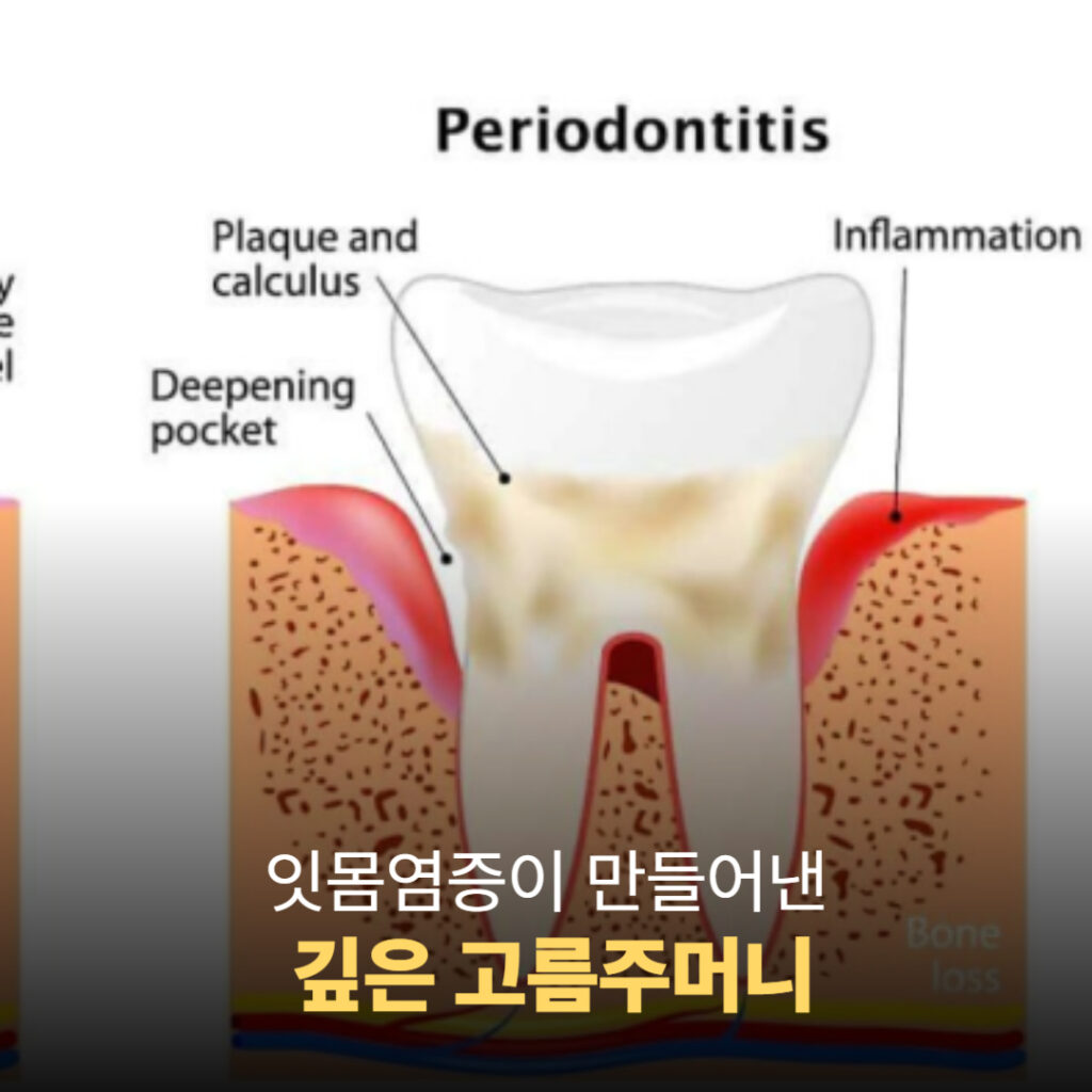 잇몸염증에 의해 형성된 깊은 고름주머니 단면 이미지