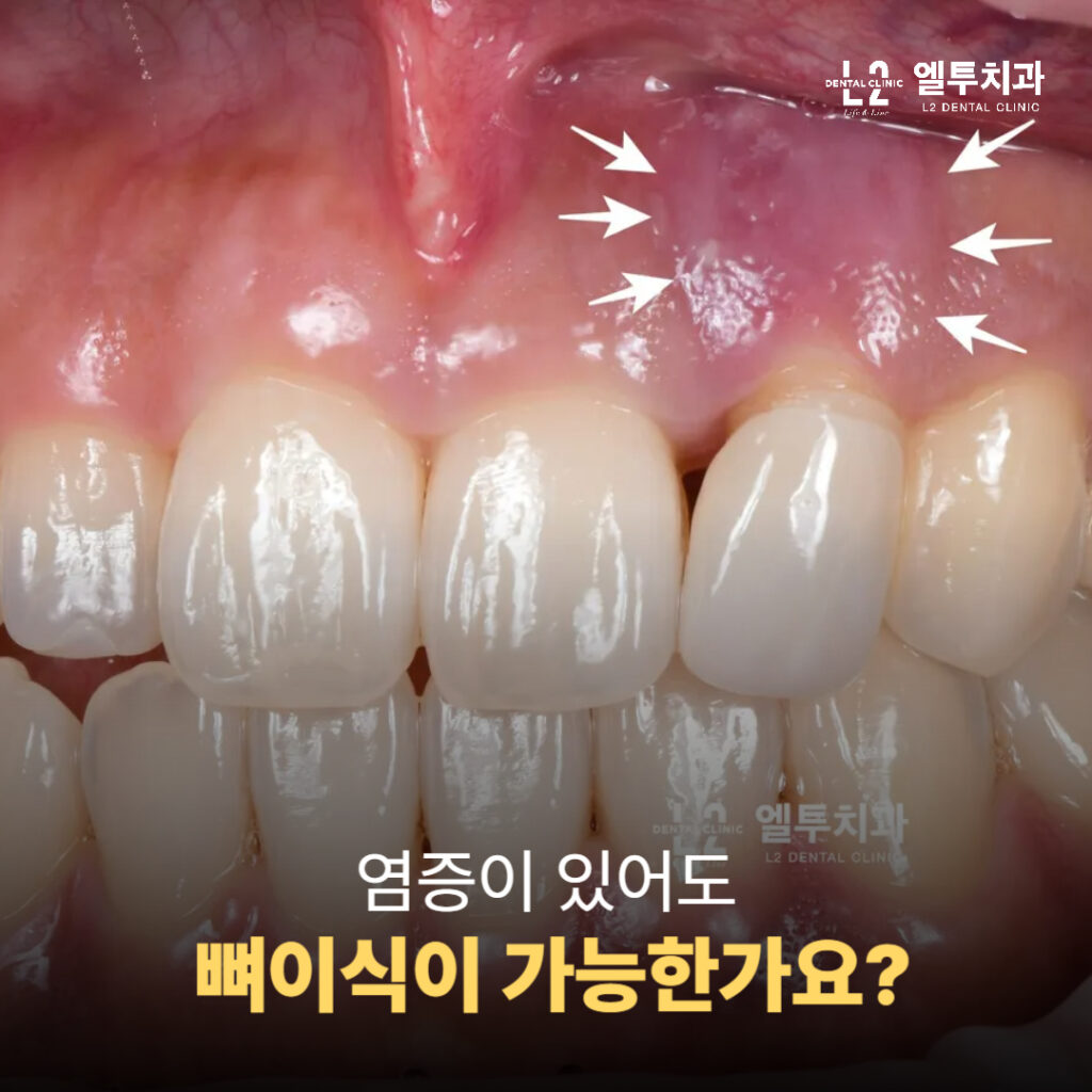 염증으로 붉게 부어오른 상악 앞니 잇몸 사진