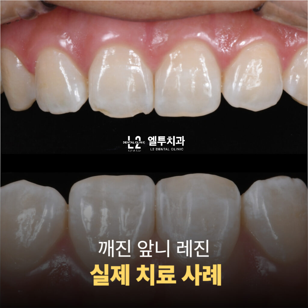 깨진 앞니 레진 치료 전후 비교 사진