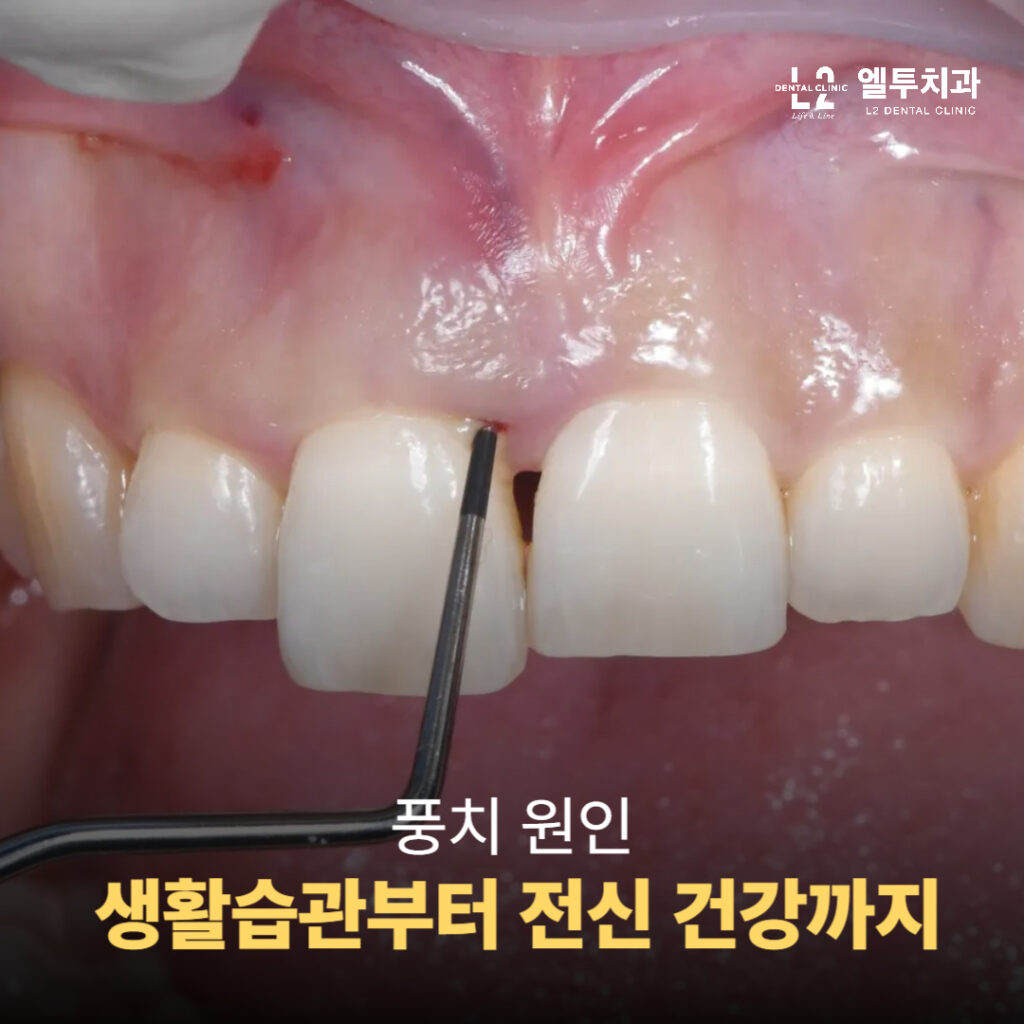 치주 탐침기로 잇몸 측정을 하는 장면
