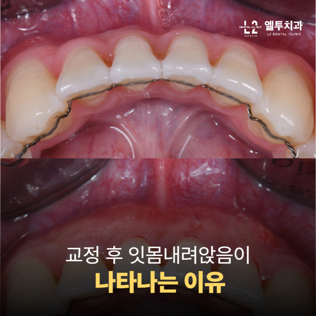 교정 치료 후 유지장치를 착용한 환자의 잇몸 모습