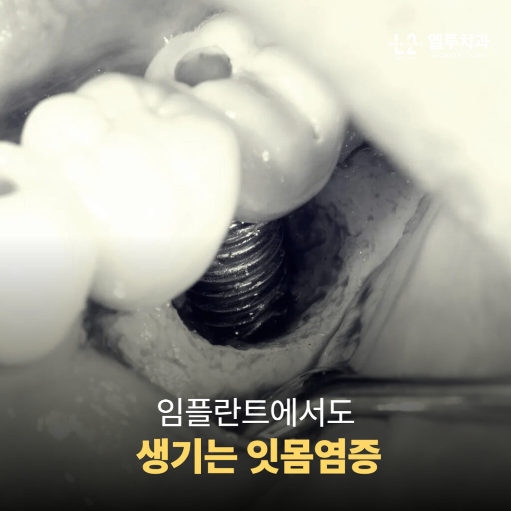 임플란트 주위에 생긴 잇몸염증 확대 사진