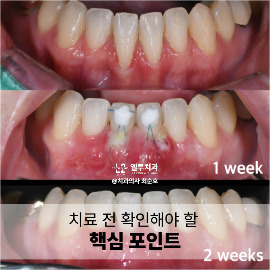 잇몸이식 수술 후 경과 모습, 1주차와 2주차 비교