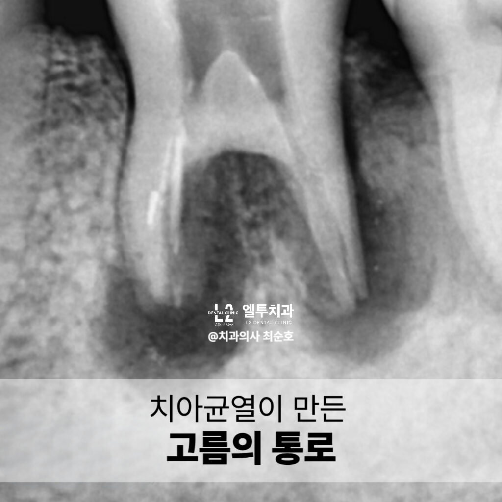 치아 균열로 인해 고름 통로가 형성된 X-ray 이미지