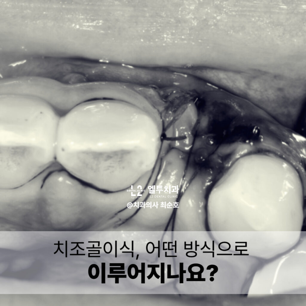 봉합된 임플란트 수술 부위 근접 촬영