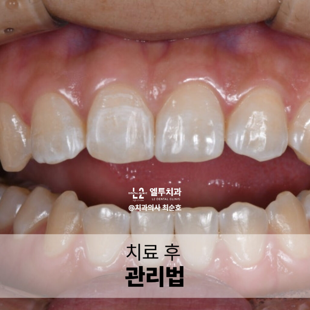 깨진 앞니 레진 치료 후 관리가 필요한 치아 모습