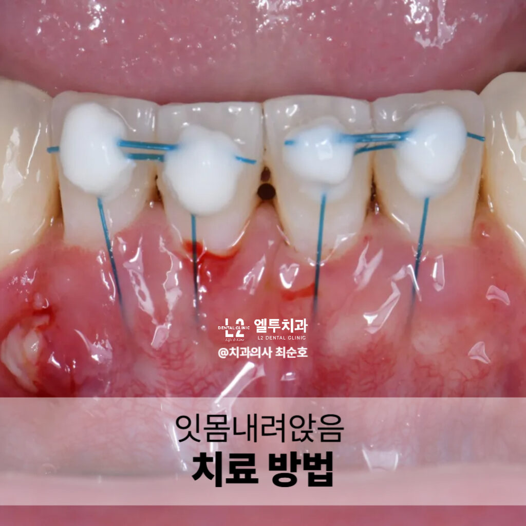 잇몸이식수술 중 봉합된 치아 뿌리 부위
