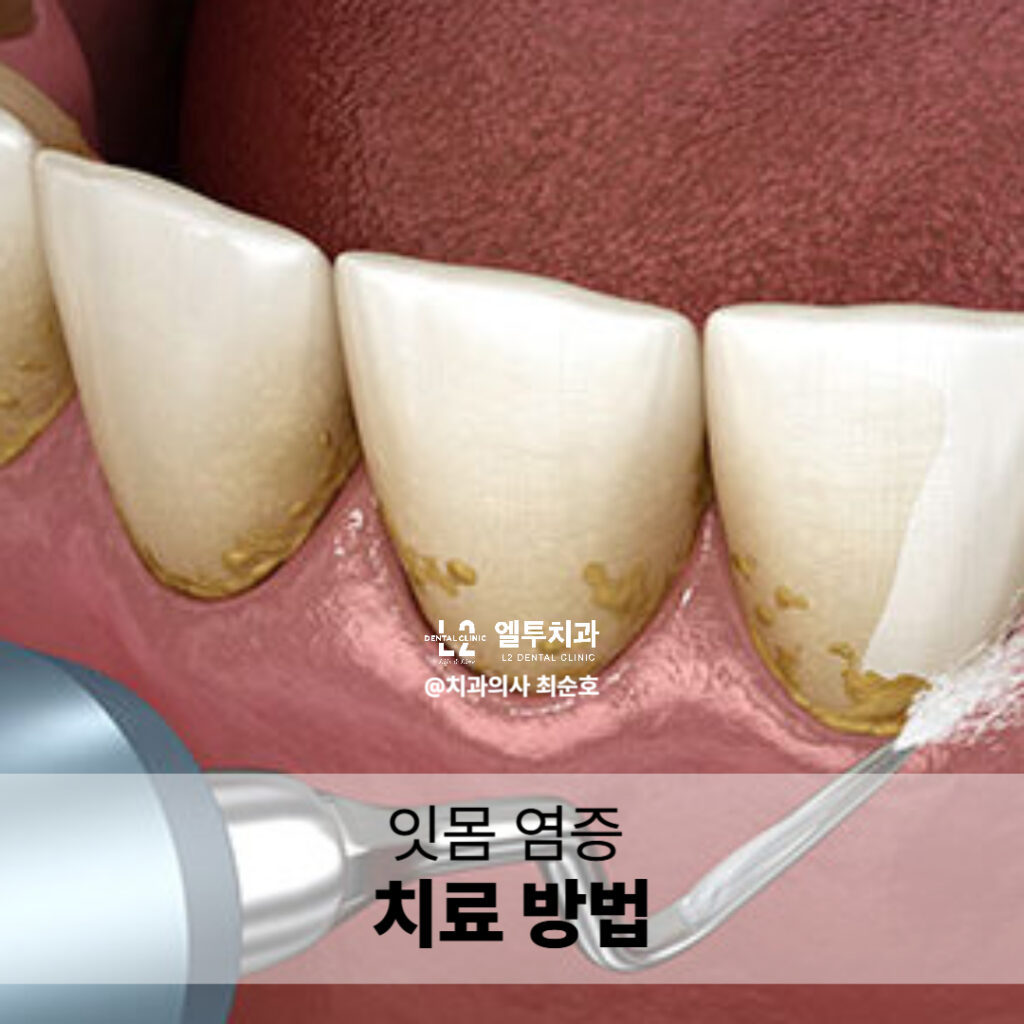 치과에서 치석 제거를 하는 잇몸 치료 장면