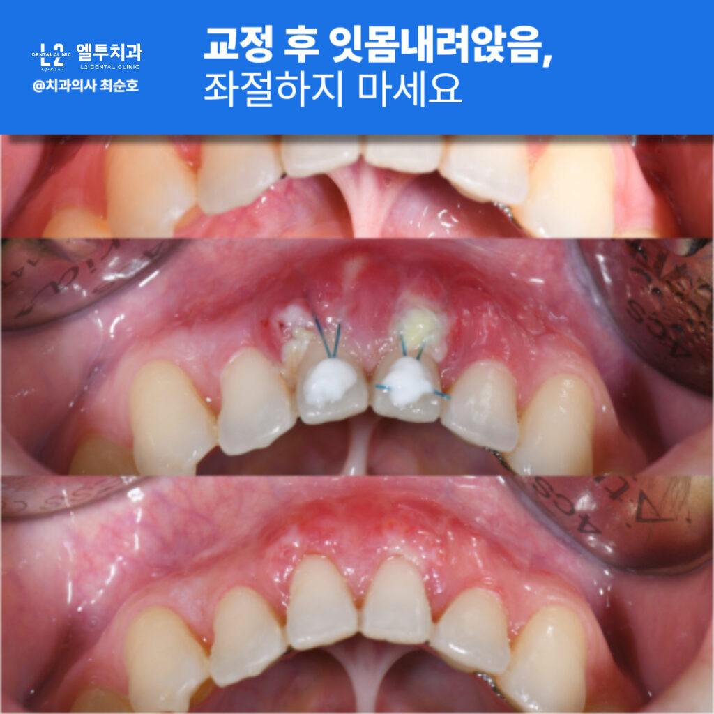 잇몸이식 수술 전후 비교 사례, 치아 사이 회복된 잇몸 모습