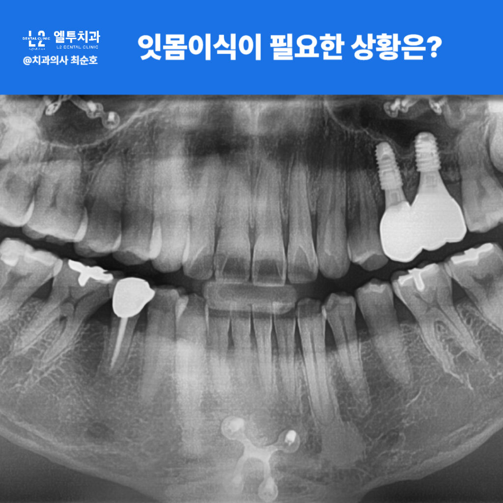잇몸이식이 필요한 임상적 상황의 파노라마 엑스레이 이미지