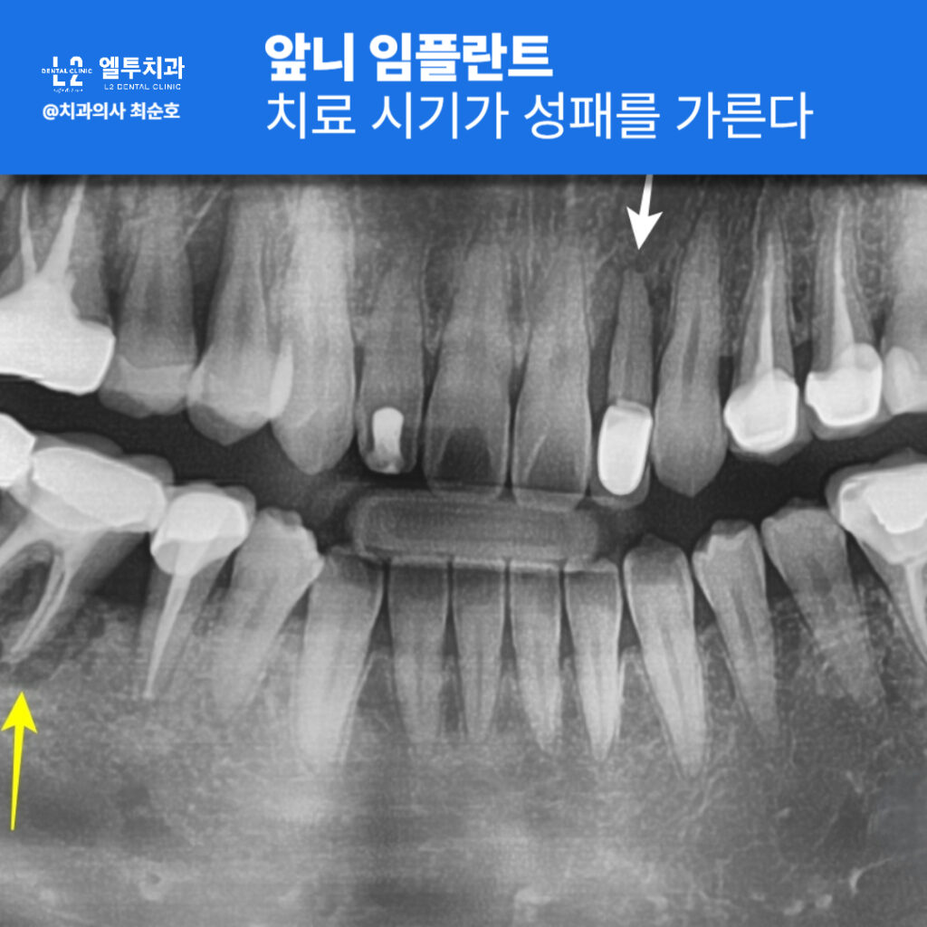 앞니 부위 X-ray 사진에 표시된 치료 필요 부위
