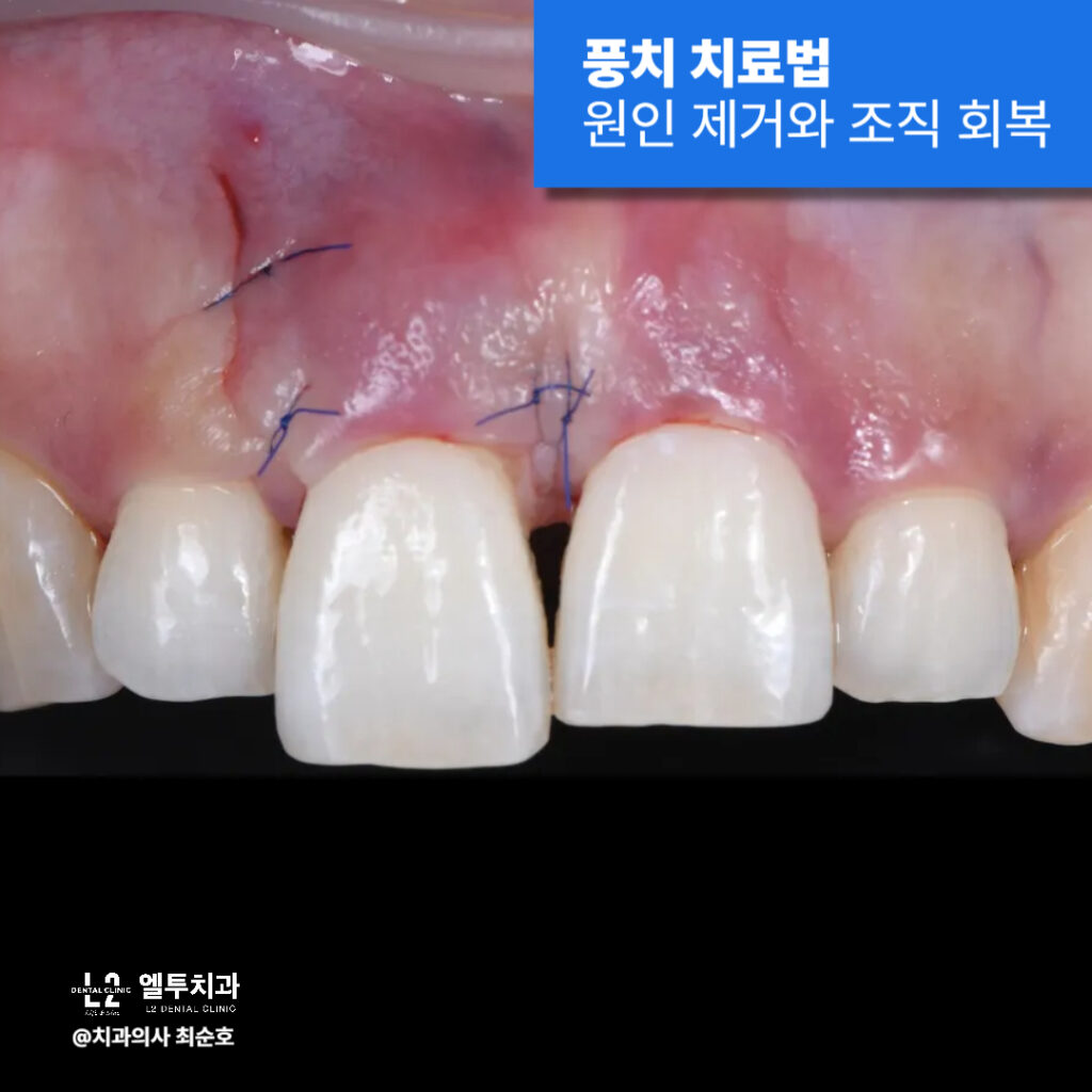 수술 봉합된 앞니 잇몸의 클로즈업