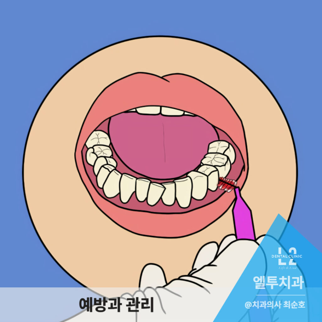 치간 칫솔을 사용하는 구강 위생 관리 그림