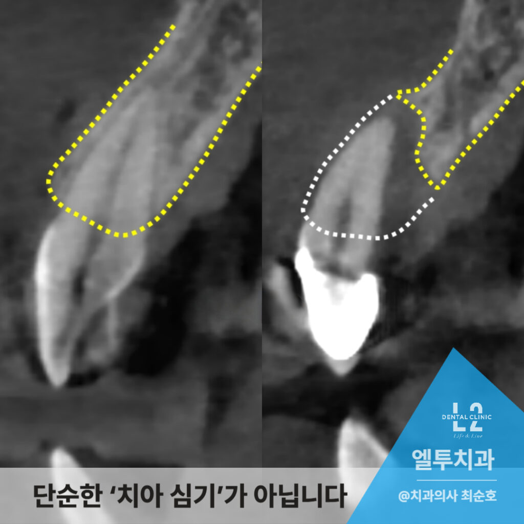 CT 영상에서 임플란트 식립 전후 치조골 비교