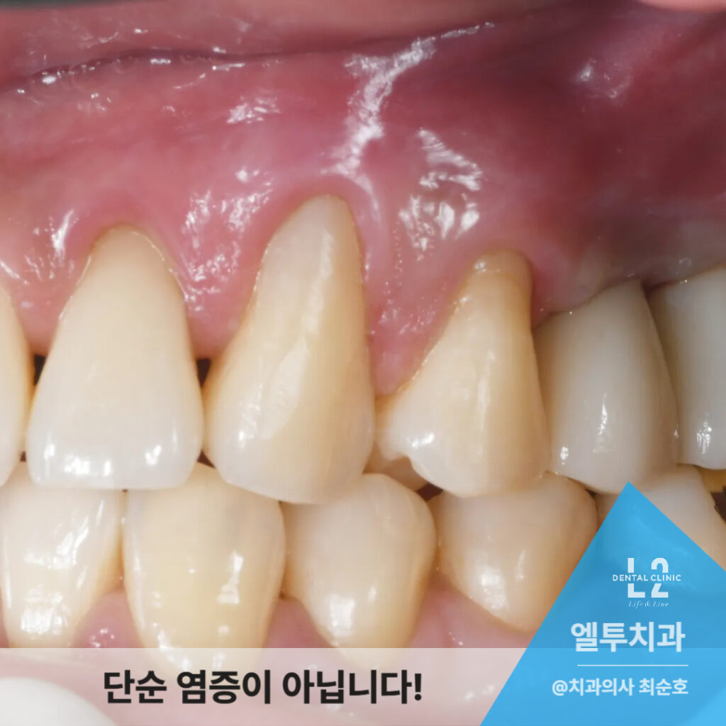 염증으로 부은 잇몸 클로즈업 임상사진