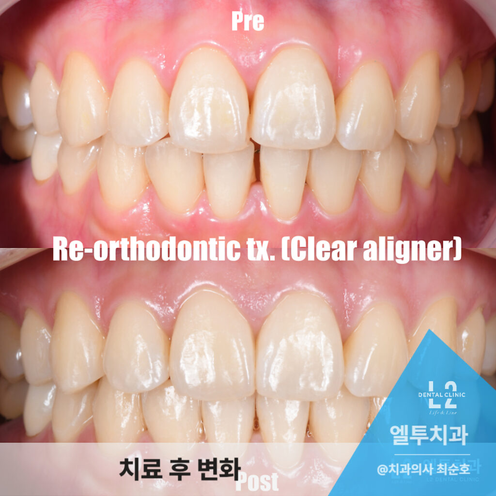 투명교정 전후 비교 사진