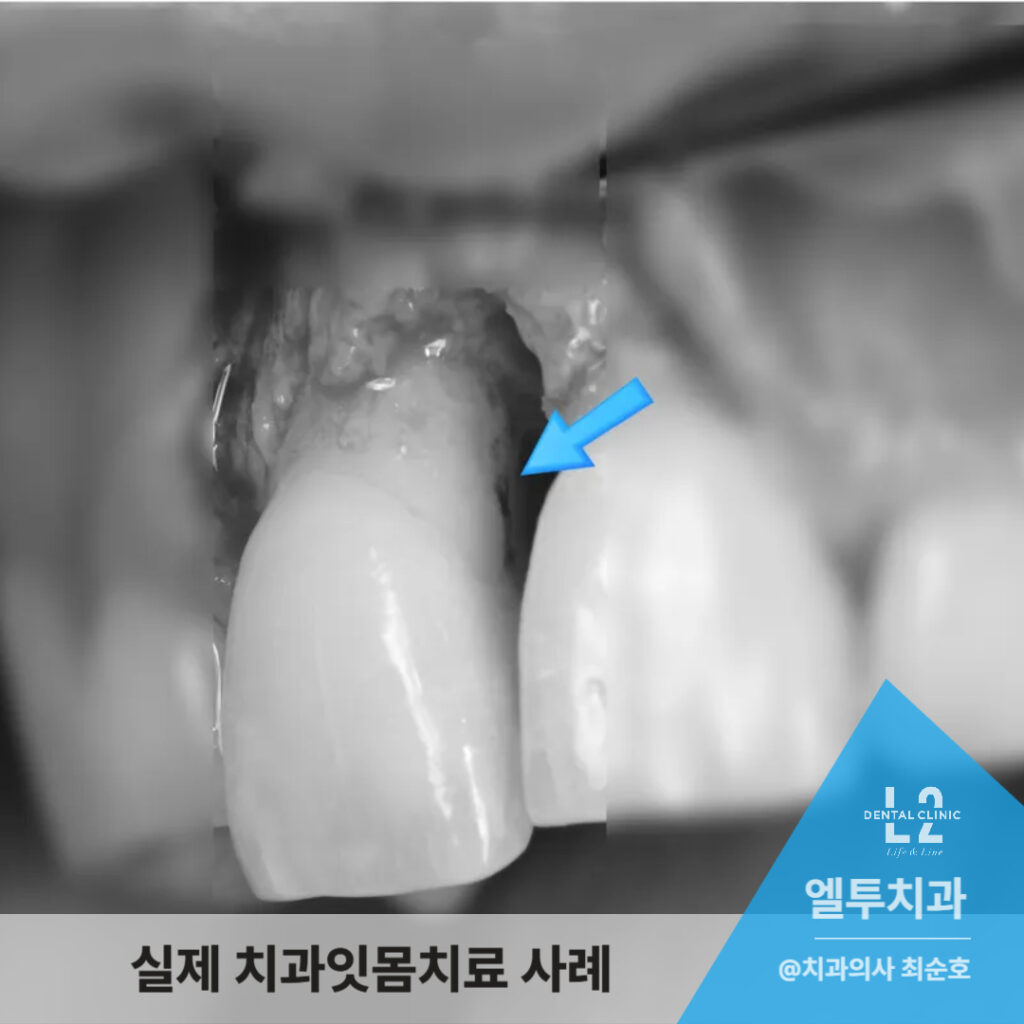 치주 수술 중 염증 부위를 노출한 흑백 구강 사진