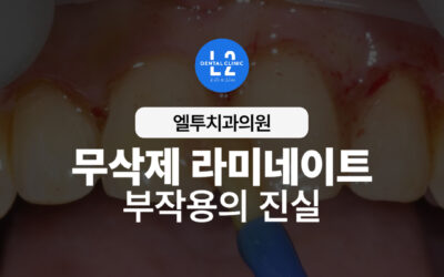 무삭제 라미네이트 부작용, 꼭 알아야 할 진실