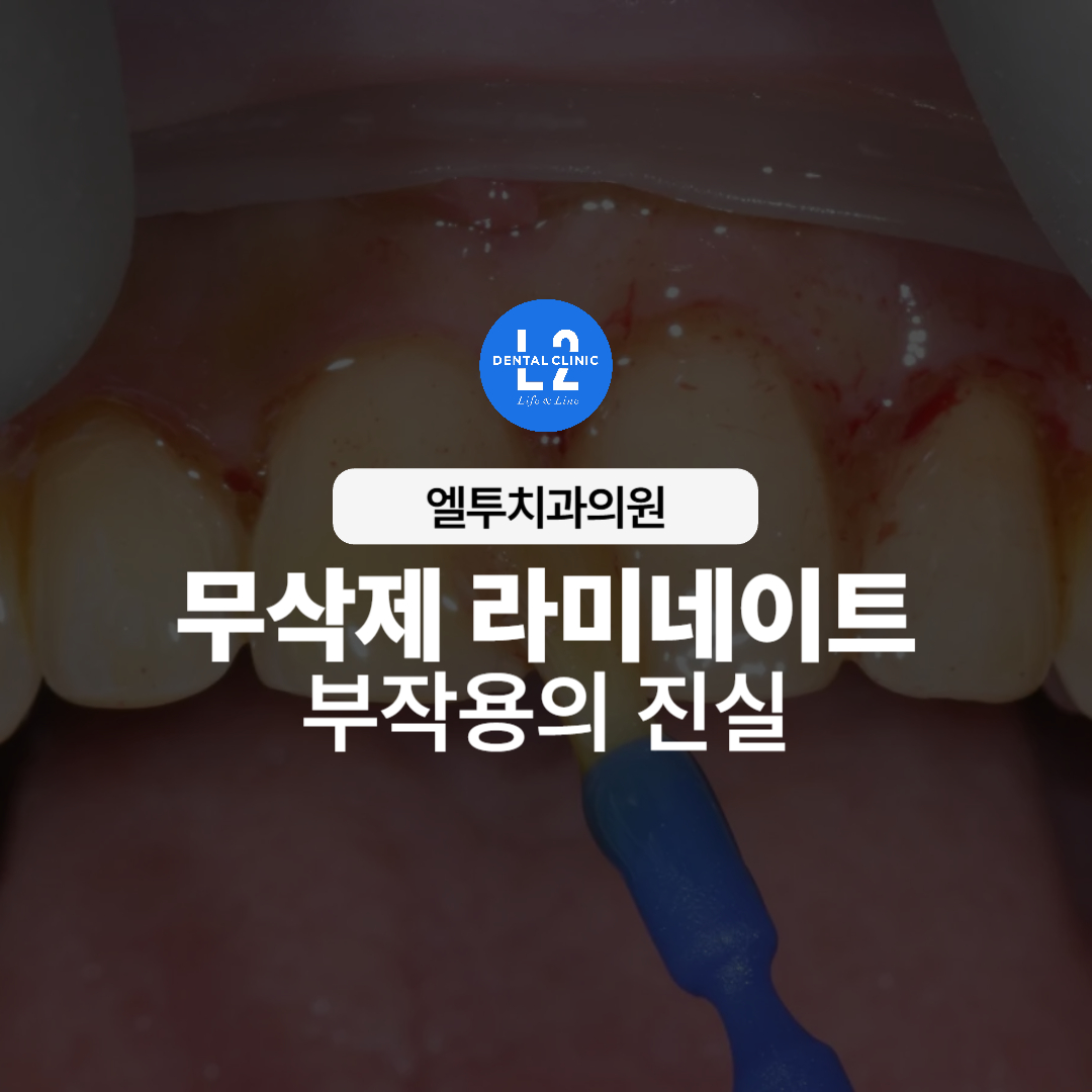무삭제 라미네이트 부작용의 진실을 설명하는 치과 이미지